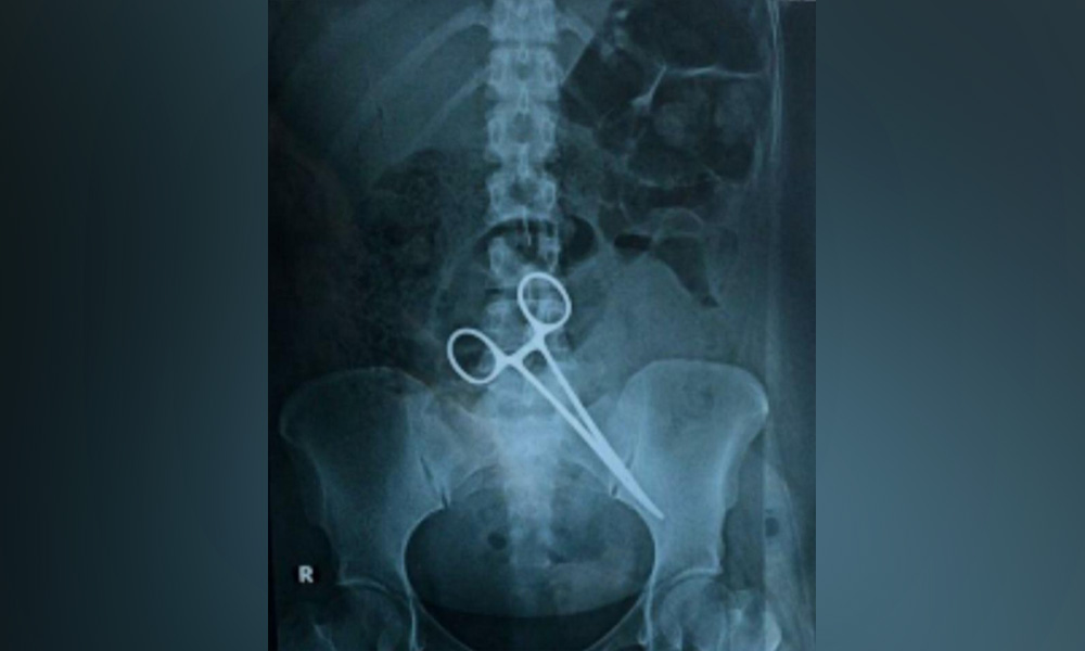 Woman undergoes second surgery after forceps left in abdomen