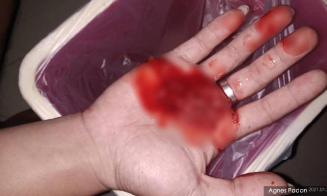 Adik batuk berdarah, aktivis khuatir sistem kesihatan S'wak pada tahap genting
