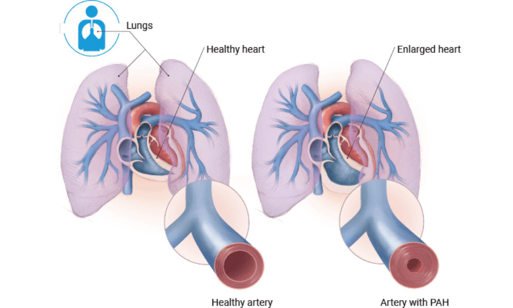 pulmonary-hypertension-a-rare-progressive-debilitating-disease